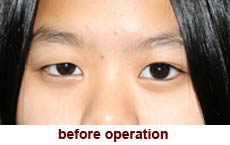 plastic-surgery-blepharoplasty